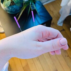 Picture of acupuncture needles in hand